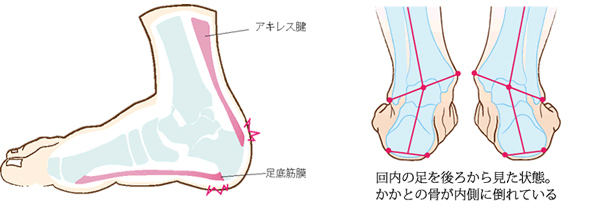 ランニング＆ウォーキングの足の痛み、今度こそ解消！