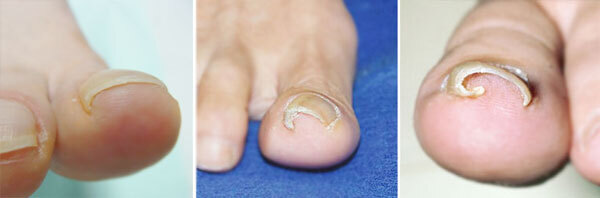 「巻き爪」治療の常識が変わった！ 再発しない最新治療「NaOH」に注目