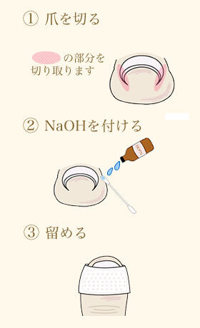 「巻き爪」治療の常識が変わった！ 再発しない最新治療「NaOH」に注目