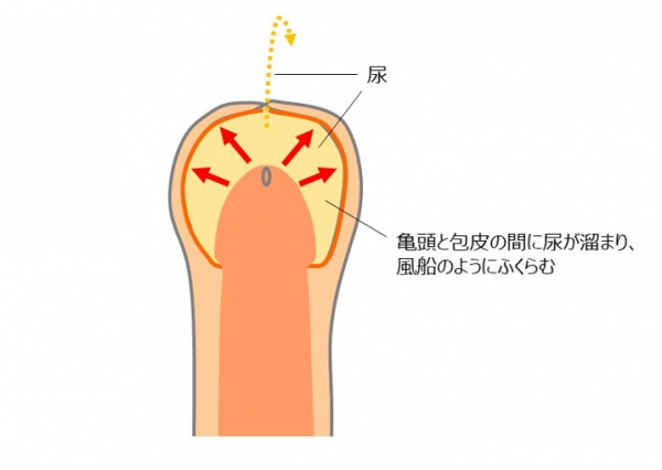 医師監修 むきむき体操 包皮翻転 は必要 子供のおちんちんトラブルについて 年2月25日 ウーマンエキサイト 4 5