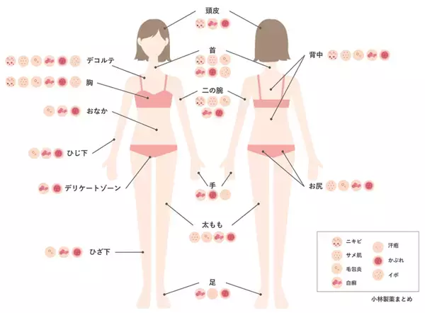 からだのブツブツ、女性の6割がトラブルが気になるまでケアしないと回答。その理由は？