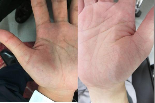 あなたは乾燥肌？簡単にチェックできる乾燥肌危険度