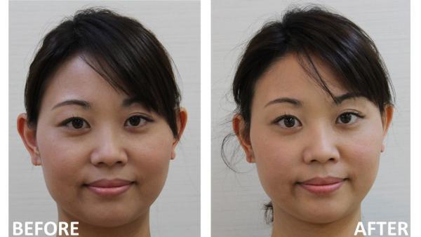 顔のセルフ筋膜リリースで自撮りをもっと美しく