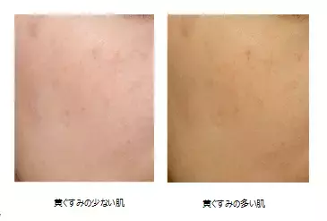 その黄ぐすみ気づいてる？もしかしたら5歳も老けて見えているかもよ