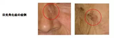 日焼け止め　1年半連用で　日光角化症に効果