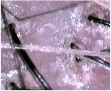 急増中　乾燥による頭皮トラブル