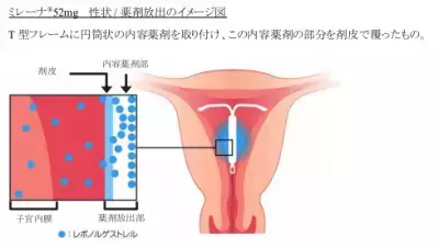 1回の装着で5年間効果が持続する月経困難症の医療用医薬品