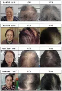 加齢による女性の薄毛は男性より治りやすい　ホームケアで改善