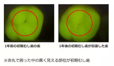 まだ間に合う!?初期むし歯を再石灰化できる特定保健用食品のガム「ポスカ」とは