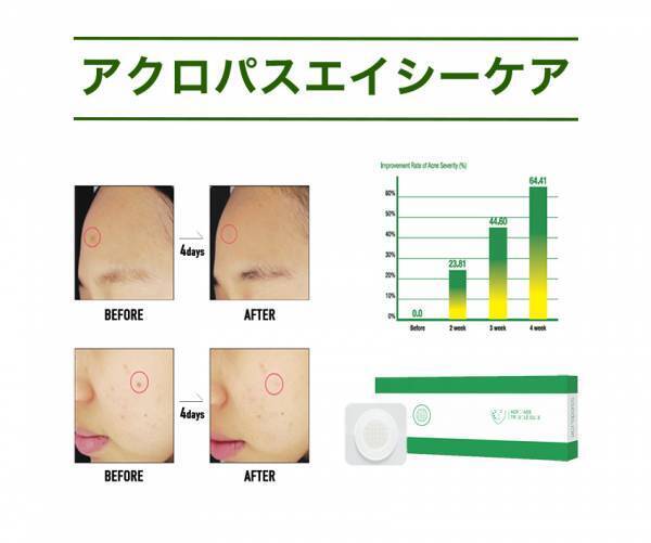マイクロニードルでニキビを治す？！新しいタイプのニキビケア商品発売