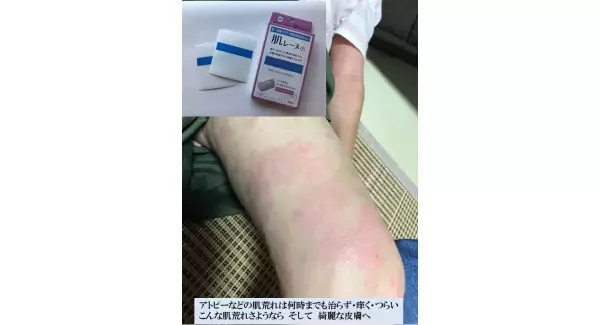 アトピー性皮膚炎・肌荒れに『肌レーヌ65』本格販売開始