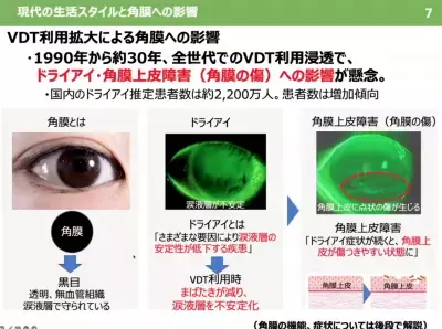 子どもにも広がる角膜リスク！デジタル社会で増加する角膜の傷と影響