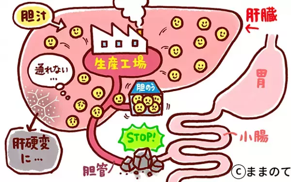 胆道閉鎖症とは？注意するべき3つの症状を知っておこう！【パパ小児科医コラムvol.16】