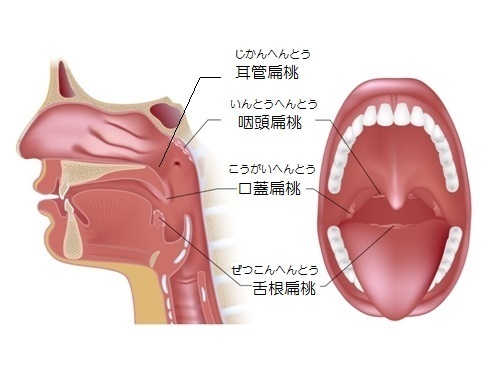 扁桃腺が腫れている？扁桃炎の症状・原因・治療法は？手術が必要な場合は？｜小児科医監修