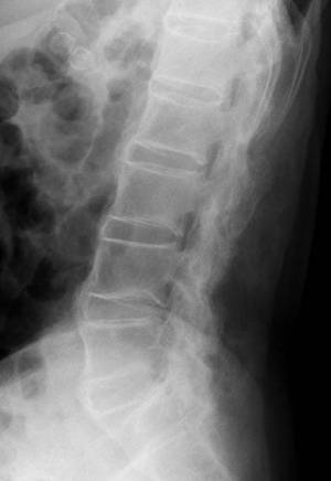 【森ノ宮医療大学】希少難病の治療ワクチンの治験開始～強直性脊椎炎に対する新治療技術～