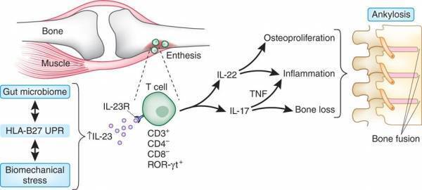 【森ノ宮医療大学】希少難病の治療ワクチンの治験開始～強直性脊椎炎に対する新治療技術～