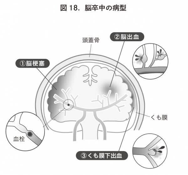 【新刊】『認知症と脳卒中は同時に予防できる』3月8日発売！長嶋茂雄氏を脳卒中から生還させた主治医・内山真一郎教授が解説（桜の花出版）