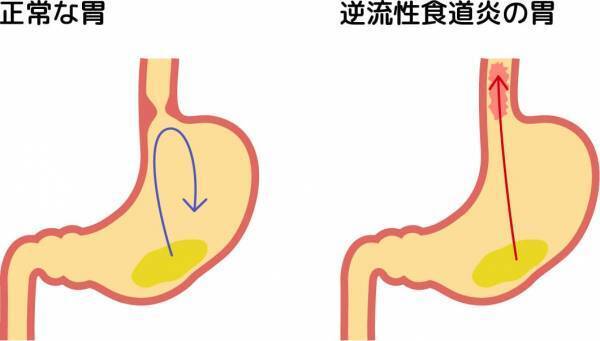 逆流性食道炎を引き起こす3つ原因を解説｜堺市いたわり健康院 さかい快福整体堂