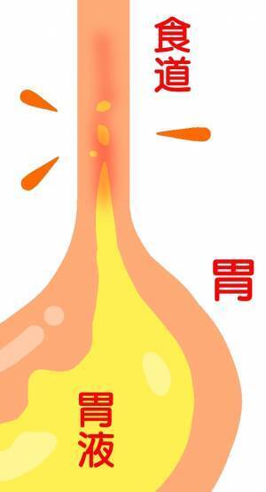 逆流性食道炎を引き起こす3つ原因を解説｜堺市いたわり健康院 さかい快福整体堂