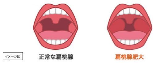 子どもは「のどの痛み」に気づきにくい!? ～かぜ薬の臨床試験結果から考察～