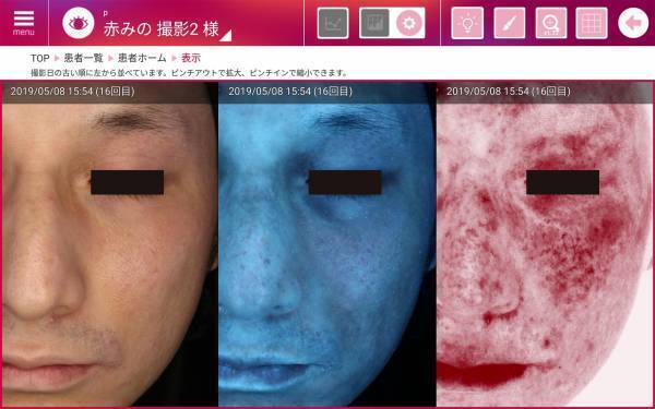 シリーズ累計500台突破！患者さまのお肌を見える化する肌画像カウンセリングシステム『re-Beau2』｜株式会社ジェイメック