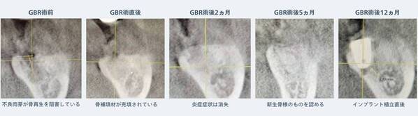 インプラント治療は「アンチエイジング」の領域へ｜幹細胞培養上清液の臨床応用から見る歯科治療の新たな可能性