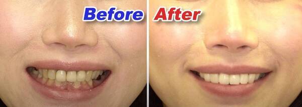 ルミネアーズ治療で美しい歯と最高の笑顔を手に入れた小河麻理子さん（Ms. Brilliant Soul 2024日本代表）、マレーシアで開催された世界大会でのグランプリ受賞おめでとう！