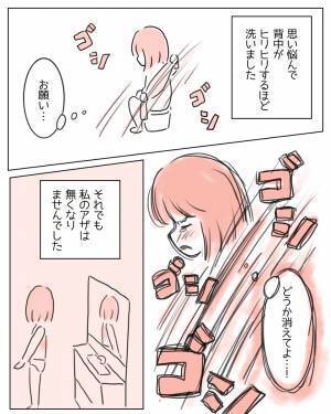 「お願い、どうか消えてよ」背中のアザをコンプレックスに思う私。ある日、‟チャーミングスカー”という言葉を知り…→読者「私も手術痕があって温泉などでよく見られて辛かった」