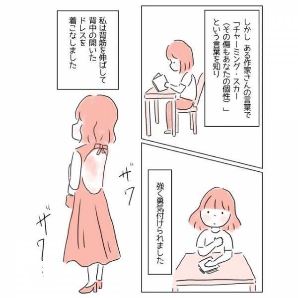 『どうか消えてよ…！』生まれつきの“背中のアザ”が嫌い！→コンプレックスを乗り越えるため【大胆な行動】に出た