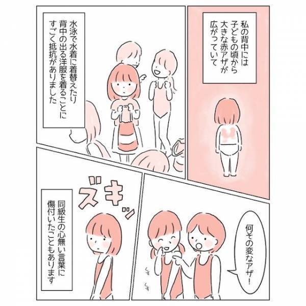 『どうか消えてよ…！』生まれつきの“背中のアザ”が嫌い！→コンプレックスを乗り越えるため【大胆な行動】に出た