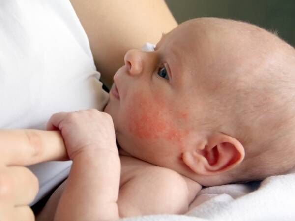 正しいスキンケアは赤ちゃんのアトピー性皮膚炎の発症や予防につながる ウーマンエキサイト 1 9