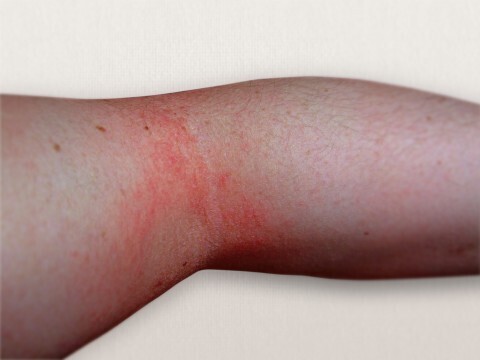 アトピーとアレルギーの違いについて