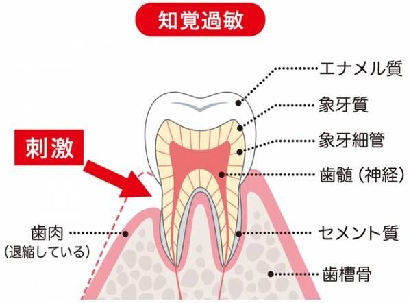 「歯がしみる…」つらい知覚過敏はなぜ起こる？対処法は？【医師解説】