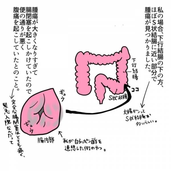 「震える…」大腸に腫瘍があることが発覚！ しかも腸閉塞を起こしかけていて… #大腸がんらしい 11