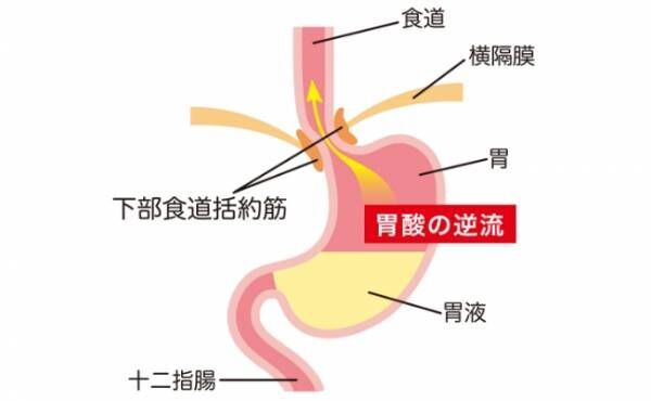 胃酸の逆流イメージ