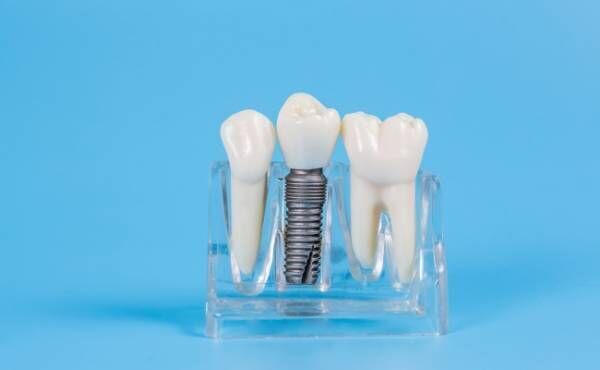 歯科インプラントのイメージ