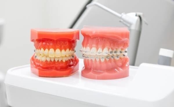 ワイヤー矯正をした歯の模型が2つ並んでいるイメージ
