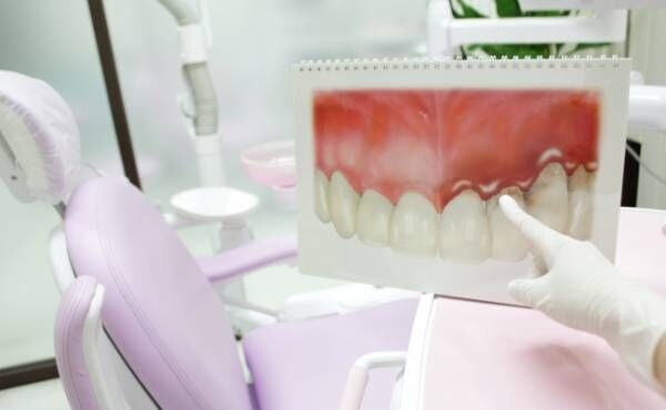 歯周病治療の説明イメージ