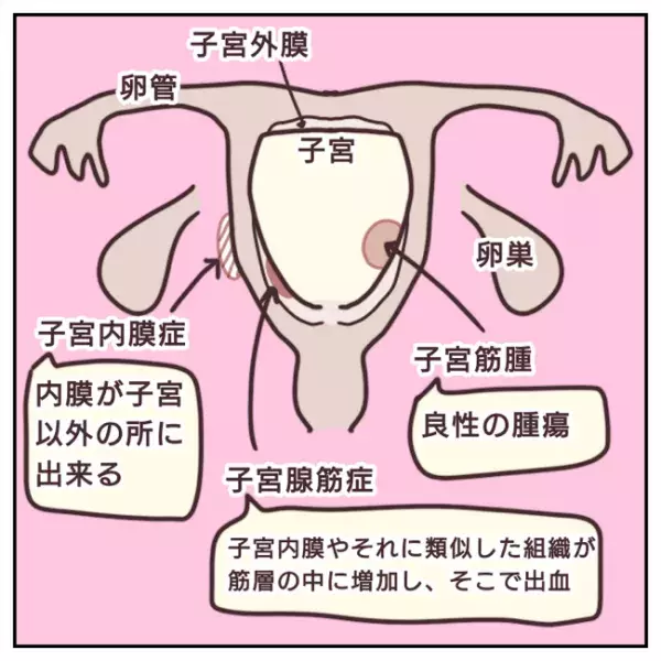 子宮筋腫で開腹手術4