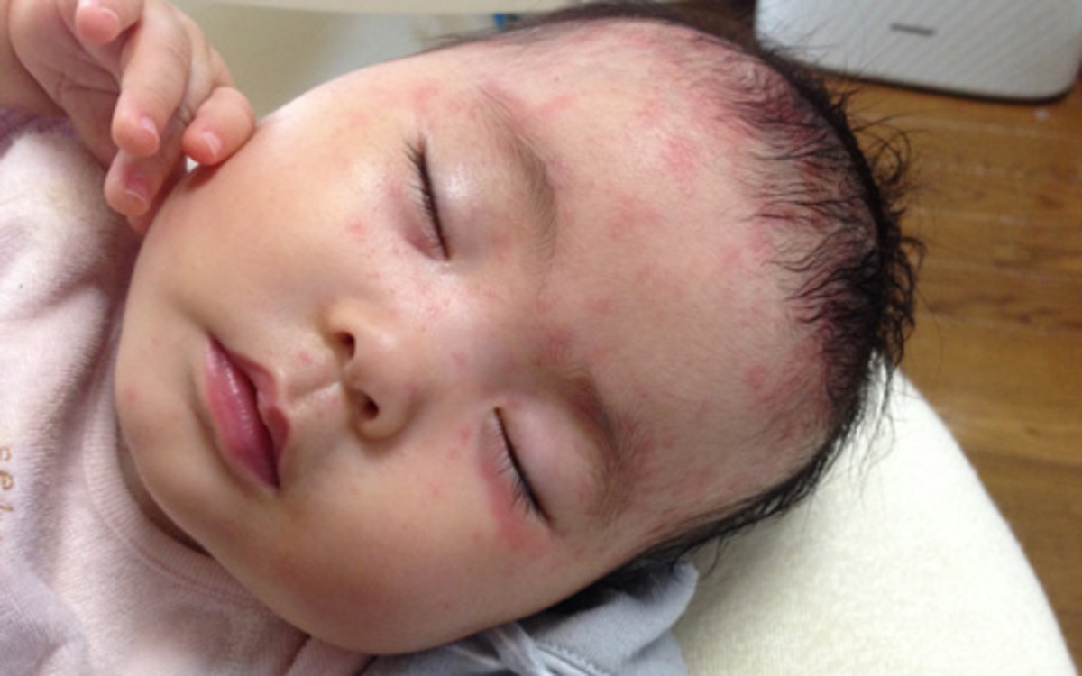 赤ちゃんの最初の発熱no1 突発性発疹について ウーマンエキサイト 1 2