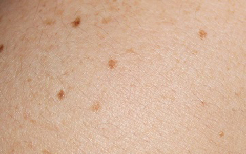 シミができる原因と解消方法