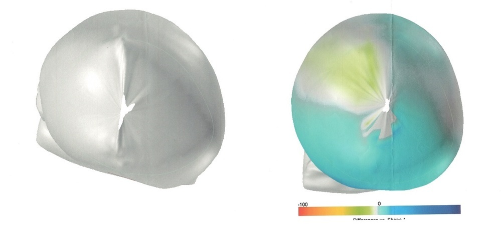 大渕弁護士がブログに綴った「頭蓋形状誘導ヘルメット」で治療した体験記