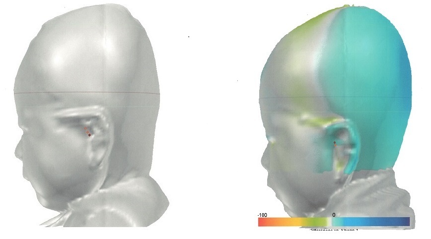 大渕弁護士がブログに綴った「頭蓋形状誘導ヘルメット」で治療した体験記