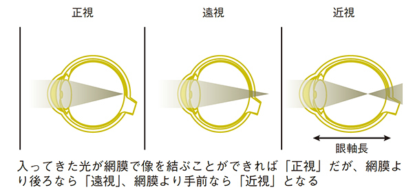 【医師監修】子どもの近視が増えている!?「あなたの子どもの目大丈夫？1」