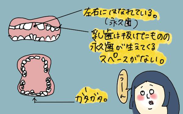 子どもの歯科矯正に40万!? 1年間頑張った成果のほどは？【コソダテフルな毎日 第89話】