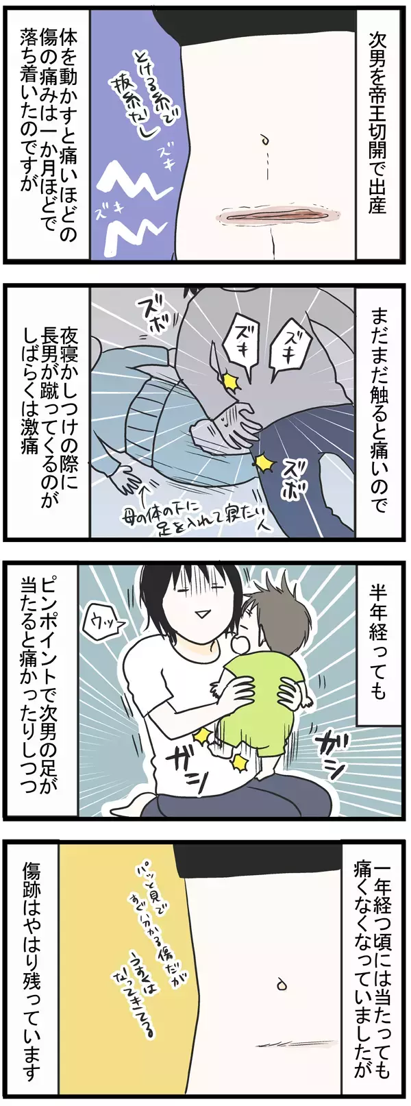 帝王切開後の生活が地味に辛い…！ 痛みと傷のその後 【うちのこざんまい 第18話】