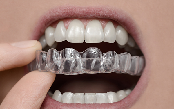 子どもの歯科矯正「費用、方法、時期どうやって選ぶ？」ママたちの体験談