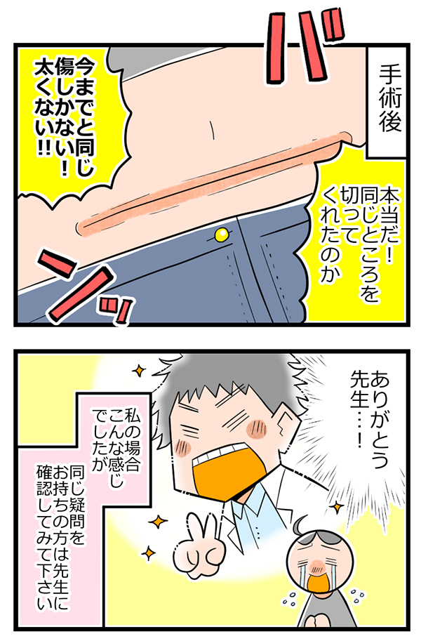 気になる帝王切開後の傷あと！ 2人目の出産後に確認すると意外な結果に【ヲタママだっていーじゃない！ 第17話】