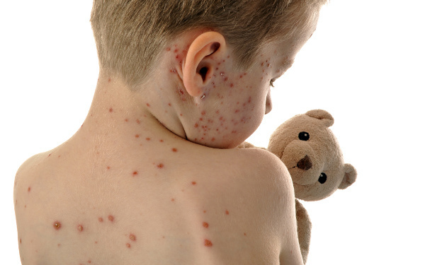 予防接種で水ぼうそうを防ごう！ ワクチンを何回打つのがベスト？【ママが知るべき「子どもの感染症」傾向と対策 第3回】