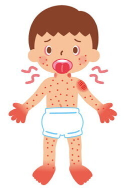 【医師監修】高熱が5日以上…「カゼではないかも？」子どもがかかる川崎病とは？＜パパ小児科医の子ども健康事典 第14話＞